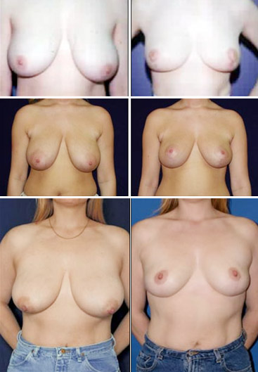 breast reduction tunisia,breast lift tunisia